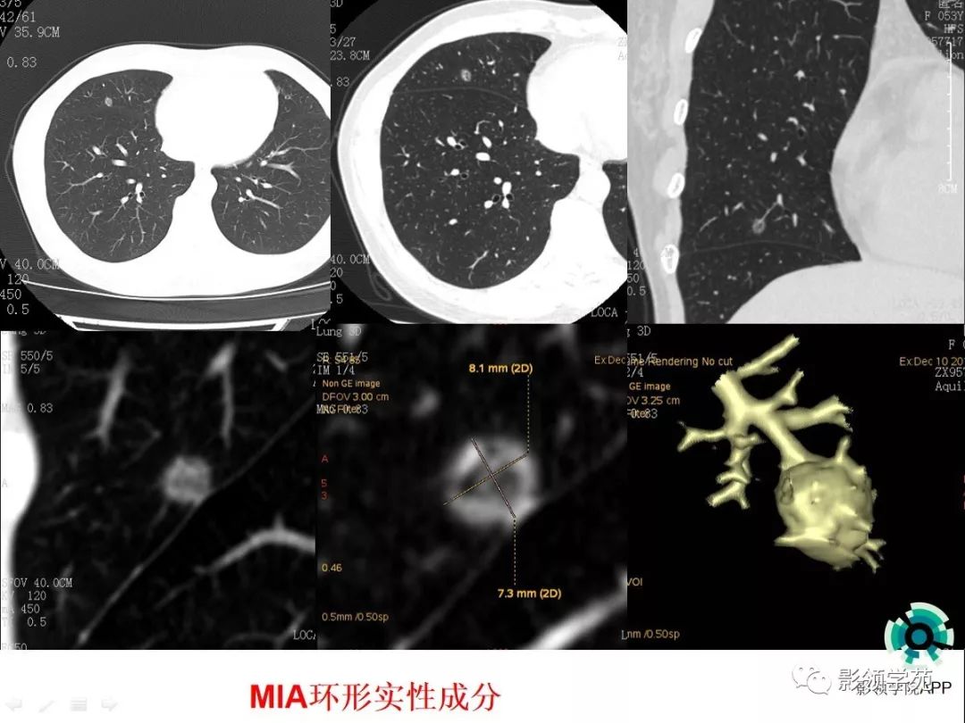 影像PPT - 【PPT】CT征象对早期肺腺癌亚型分型价值探讨（一）-44