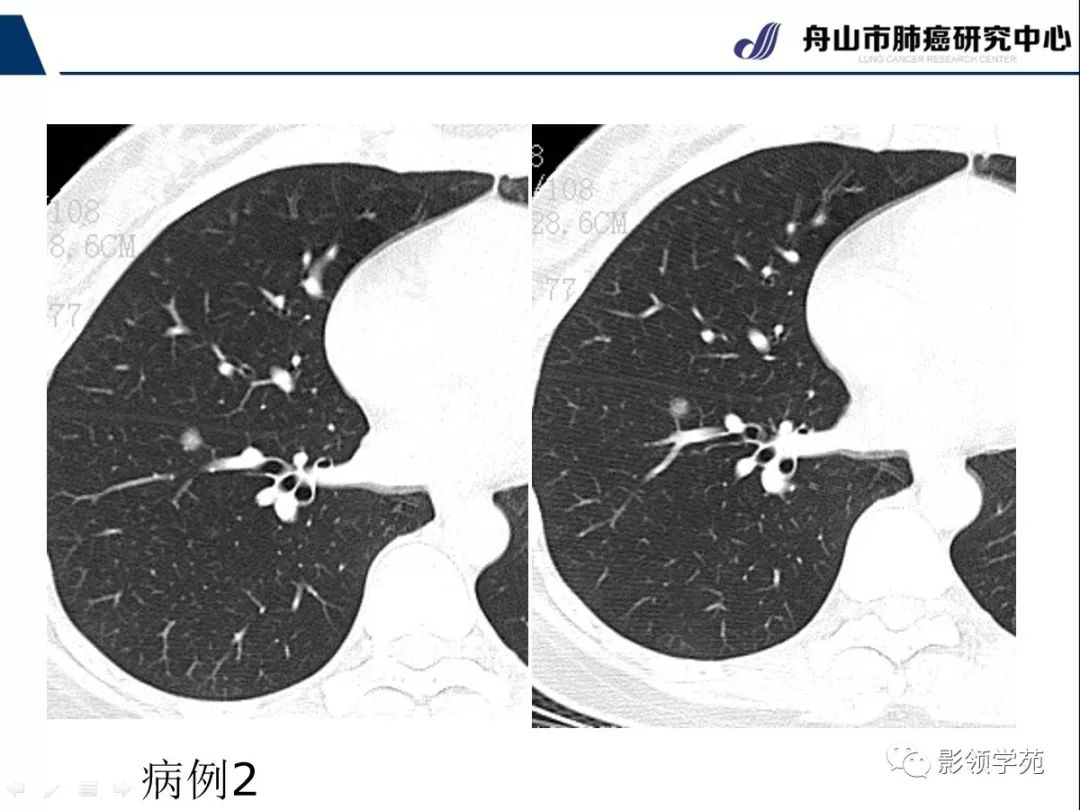 影像PPT - 【PPT】CT征象对早期肺腺癌亚型分型价值探讨—平均CT值测量-4 影像PPT - 【PPT】CT征象对早期肺腺癌亚型分型价值探讨—平均CT值测量-4