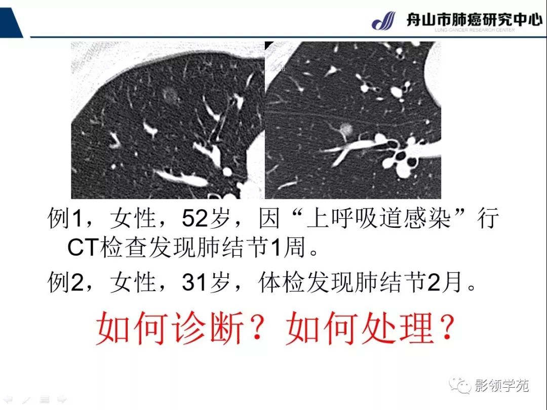 影像PPT - 【PPT】CT征象对早期肺腺癌亚型分型价值探讨—平均CT值测量-7 影像PPT - 【PPT】CT征象对早期肺腺癌亚型分型价值探讨—平均CT值测量-7