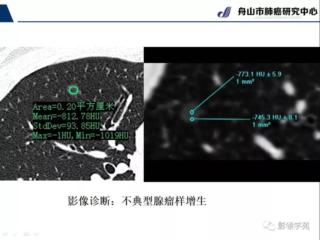 影像PPT - 【PPT】CT征象对早期肺腺癌亚型分型价值探讨—平均CT值测量-8 影像PPT - 【PPT】CT征象对早期肺腺癌亚型分型价值探讨—平均CT值测量-8