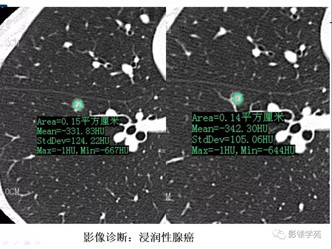 影像PPT - 【PPT】CT征象对早期肺腺癌亚型分型价值探讨—平均CT值测量-9 影像PPT - 【PPT】CT征象对早期肺腺癌亚型分型价值探讨—平均CT值测量-9