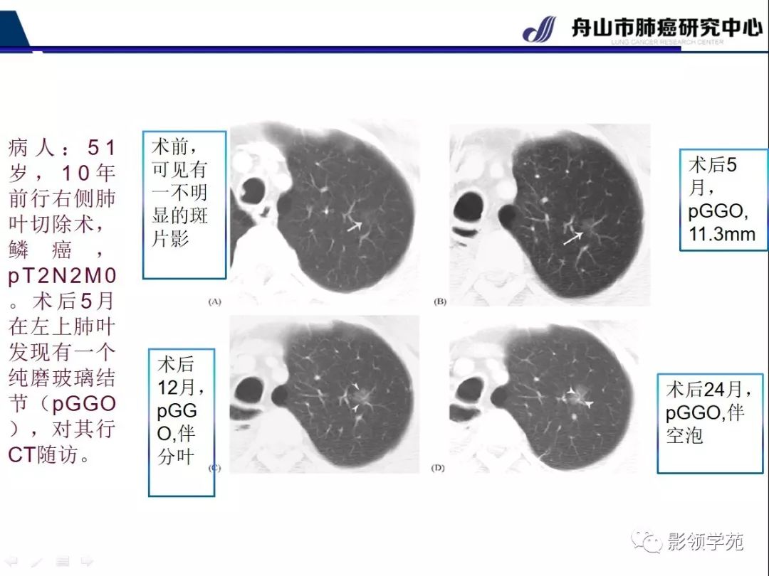 影像PPT - 【PPT】CT征象对早期肺腺癌亚型分型价值探讨—平均CT值测量-12 影像PPT - 【PPT】CT征象对早期肺腺癌亚型分型价值探讨—平均CT值测量-12