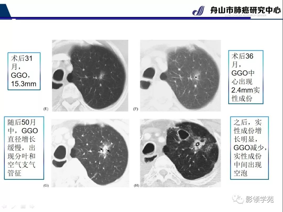 影像PPT - 【PPT】CT征象对早期肺腺癌亚型分型价值探讨—平均CT值测量-13 影像PPT - 【PPT】CT征象对早期肺腺癌亚型分型价值探讨—平均CT值测量-13