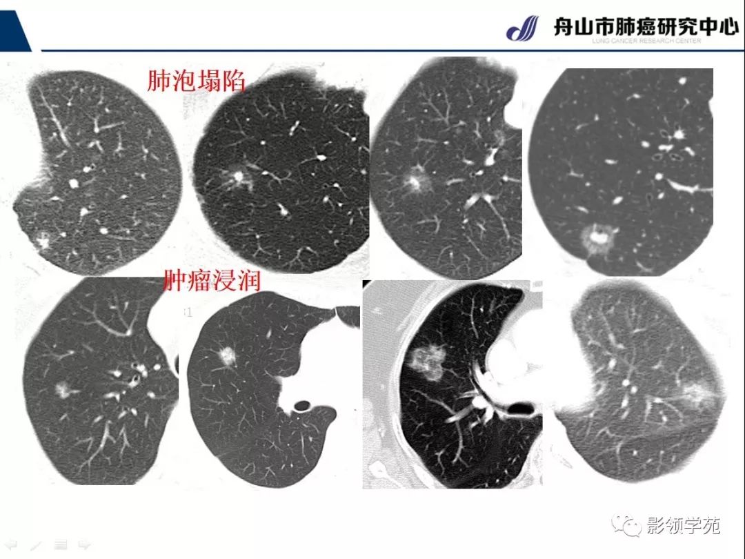 影像PPT - 【PPT】CT征象对早期肺腺癌亚型分型价值探讨—平均CT值测量-17 影像PPT - 【PPT】CT征象对早期肺腺癌亚型分型价值探讨—平均CT值测量-17