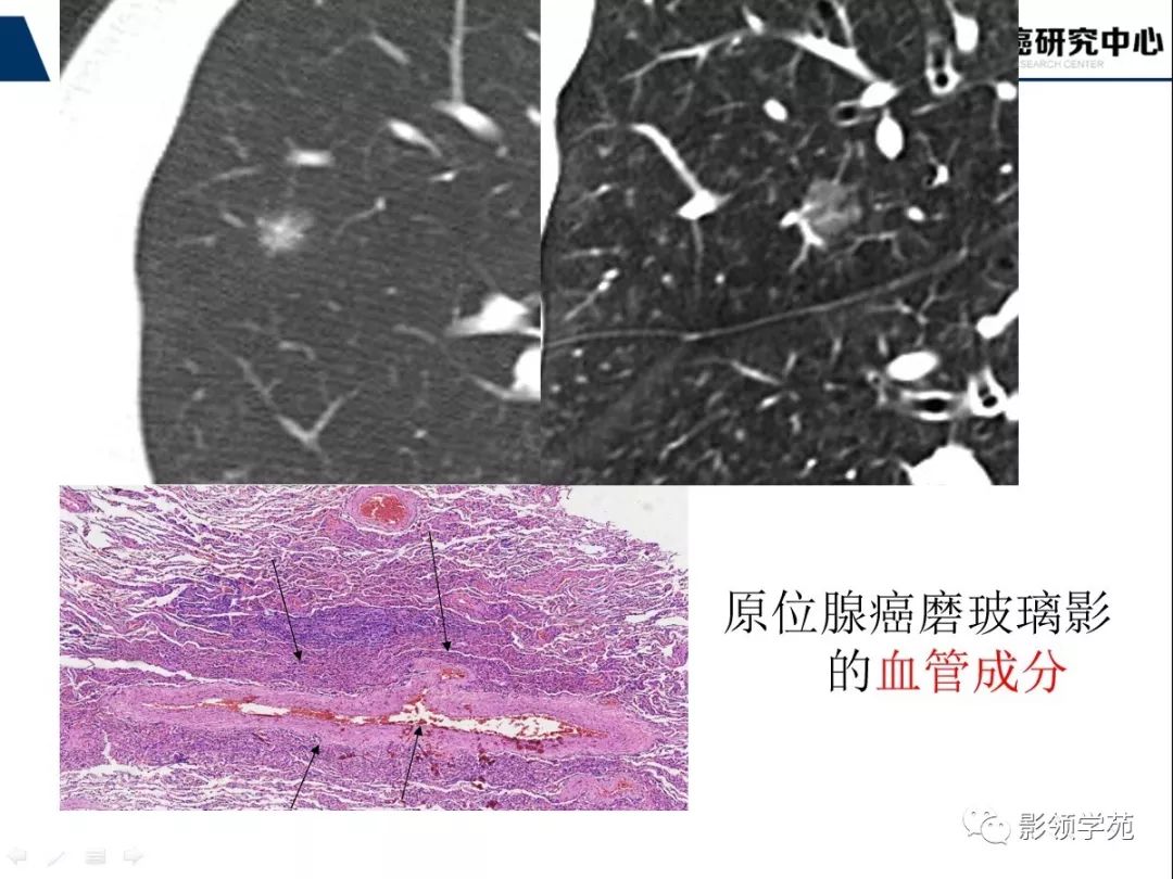 影像PPT - 【PPT】CT征象对早期肺腺癌亚型分型价值探讨—平均CT值测量-18 影像PPT - 【PPT】CT征象对早期肺腺癌亚型分型价值探讨—平均CT值测量-18