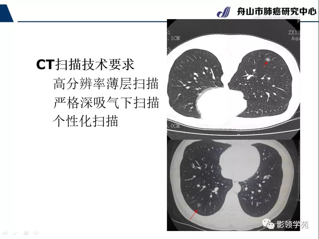影像PPT - 【PPT】CT征象对早期肺腺癌亚型分型价值探讨—平均CT值测量-27 影像PPT - 【PPT】CT征象对早期肺腺癌亚型分型价值探讨—平均CT值测量-27