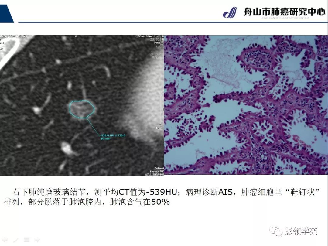 影像PPT - 【PPT】CT征象对早期肺腺癌亚型分型价值探讨—平均CT值测量-29 影像PPT - 【PPT】CT征象对早期肺腺癌亚型分型价值探讨—平均CT值测量-29