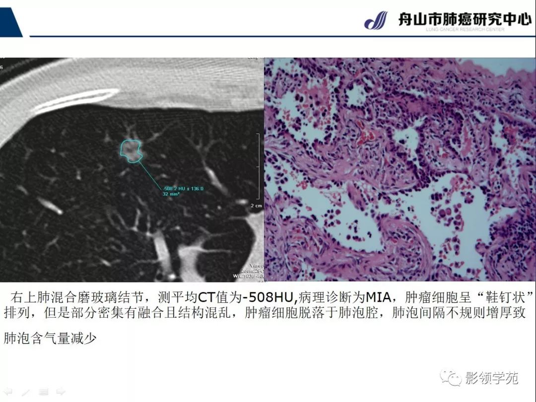 影像PPT - 【PPT】CT征象对早期肺腺癌亚型分型价值探讨—平均CT值测量-30 影像PPT - 【PPT】CT征象对早期肺腺癌亚型分型价值探讨—平均CT值测量-30