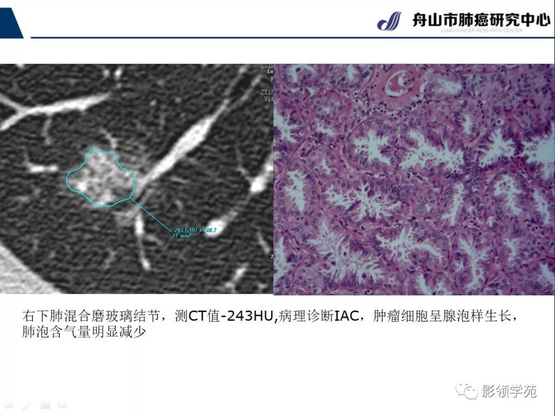 影像PPT - 【PPT】CT征象对早期肺腺癌亚型分型价值探讨—平均CT值测量-31 影像PPT - 【PPT】CT征象对早期肺腺癌亚型分型价值探讨—平均CT值测量-31