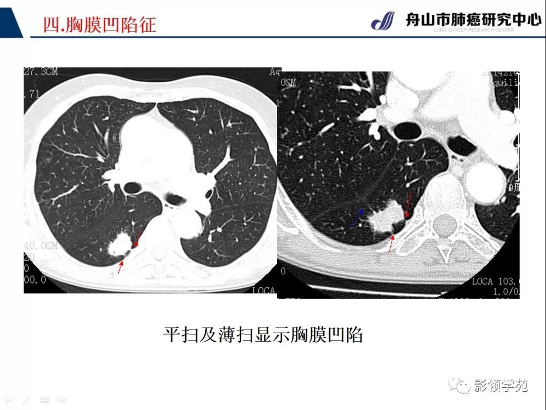 影像PPT - 【PPT】CT征象对早期肺腺癌亚型分型价值探讨—胸膜凹陷征-6 影像PPT - 【PPT】CT征象对早期肺腺癌亚型分型价值探讨—胸膜凹陷征-6