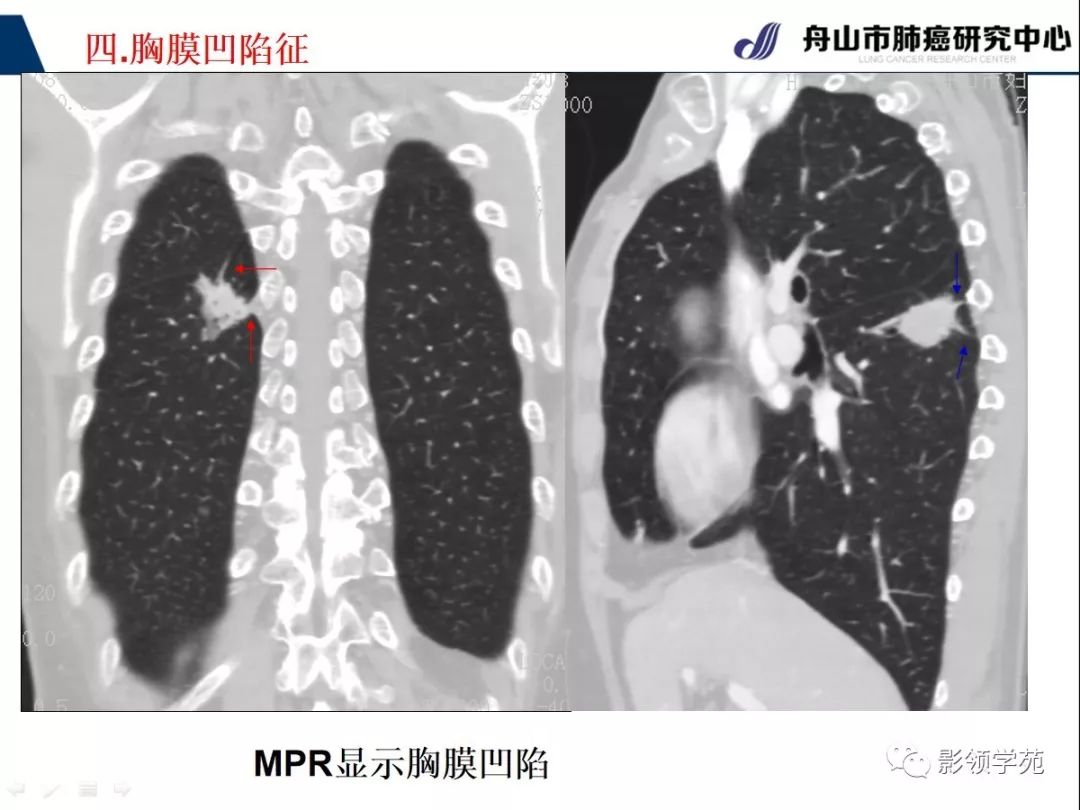 影像PPT - 【PPT】CT征象对早期肺腺癌亚型分型价值探讨—胸膜凹陷征-7 影像PPT - 【PPT】CT征象对早期肺腺癌亚型分型价值探讨—胸膜凹陷征-7