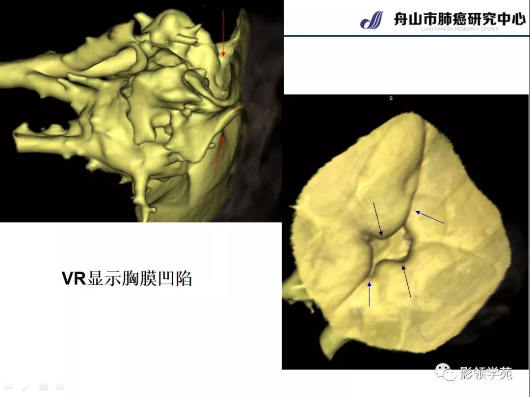 影像PPT - 【PPT】CT征象对早期肺腺癌亚型分型价值探讨—胸膜凹陷征-8 影像PPT - 【PPT】CT征象对早期肺腺癌亚型分型价值探讨—胸膜凹陷征-8
