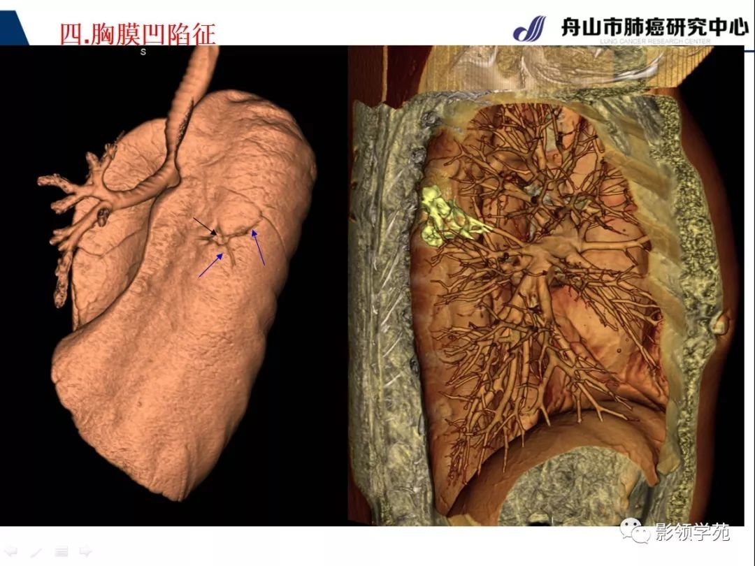 影像PPT - 【PPT】CT征象对早期肺腺癌亚型分型价值探讨—胸膜凹陷征-9 影像PPT - 【PPT】CT征象对早期肺腺癌亚型分型价值探讨—胸膜凹陷征-9