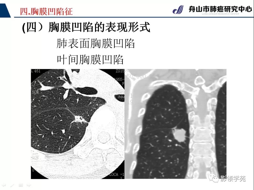 影像PPT - 【PPT】CT征象对早期肺腺癌亚型分型价值探讨—胸膜凹陷征-10 影像PPT - 【PPT】CT征象对早期肺腺癌亚型分型价值探讨—胸膜凹陷征-10