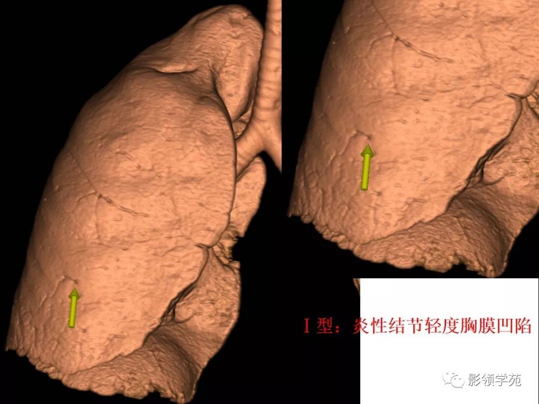 影像PPT - 【PPT】CT征象对早期肺腺癌亚型分型价值探讨—胸膜凹陷征-15 影像PPT - 【PPT】CT征象对早期肺腺癌亚型分型价值探讨—胸膜凹陷征-15