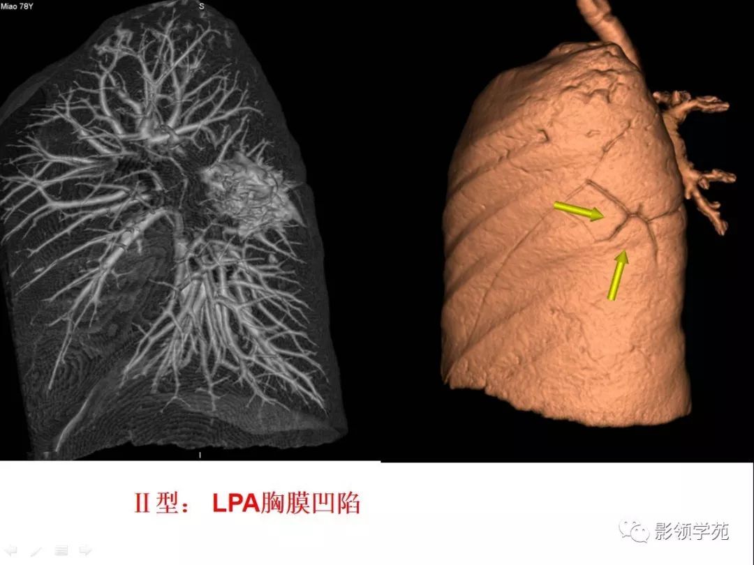 影像PPT - 【PPT】CT征象对早期肺腺癌亚型分型价值探讨—胸膜凹陷征-17 影像PPT - 【PPT】CT征象对早期肺腺癌亚型分型价值探讨—胸膜凹陷征-17