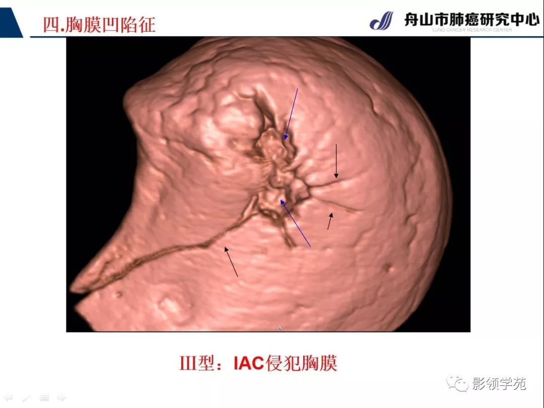 影像PPT - 【PPT】CT征象对早期肺腺癌亚型分型价值探讨—胸膜凹陷征-19 影像PPT - 【PPT】CT征象对早期肺腺癌亚型分型价值探讨—胸膜凹陷征-19