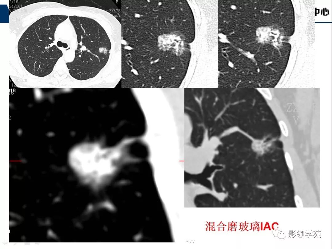 影像PPT - 【PPT】CT征象对早期肺腺癌亚型分型价值探讨—胸膜凹陷征-21 影像PPT - 【PPT】CT征象对早期肺腺癌亚型分型价值探讨—胸膜凹陷征-21