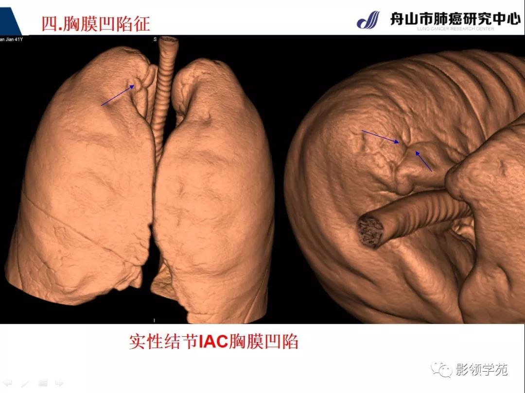 影像PPT - 【PPT】CT征象对早期肺腺癌亚型分型价值探讨—胸膜凹陷征-24 影像PPT - 【PPT】CT征象对早期肺腺癌亚型分型价值探讨—胸膜凹陷征-24