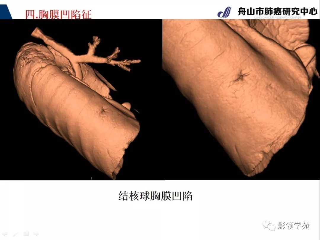 影像PPT - 【PPT】CT征象对早期肺腺癌亚型分型价值探讨—胸膜凹陷征-27 影像PPT - 【PPT】CT征象对早期肺腺癌亚型分型价值探讨—胸膜凹陷征-27
