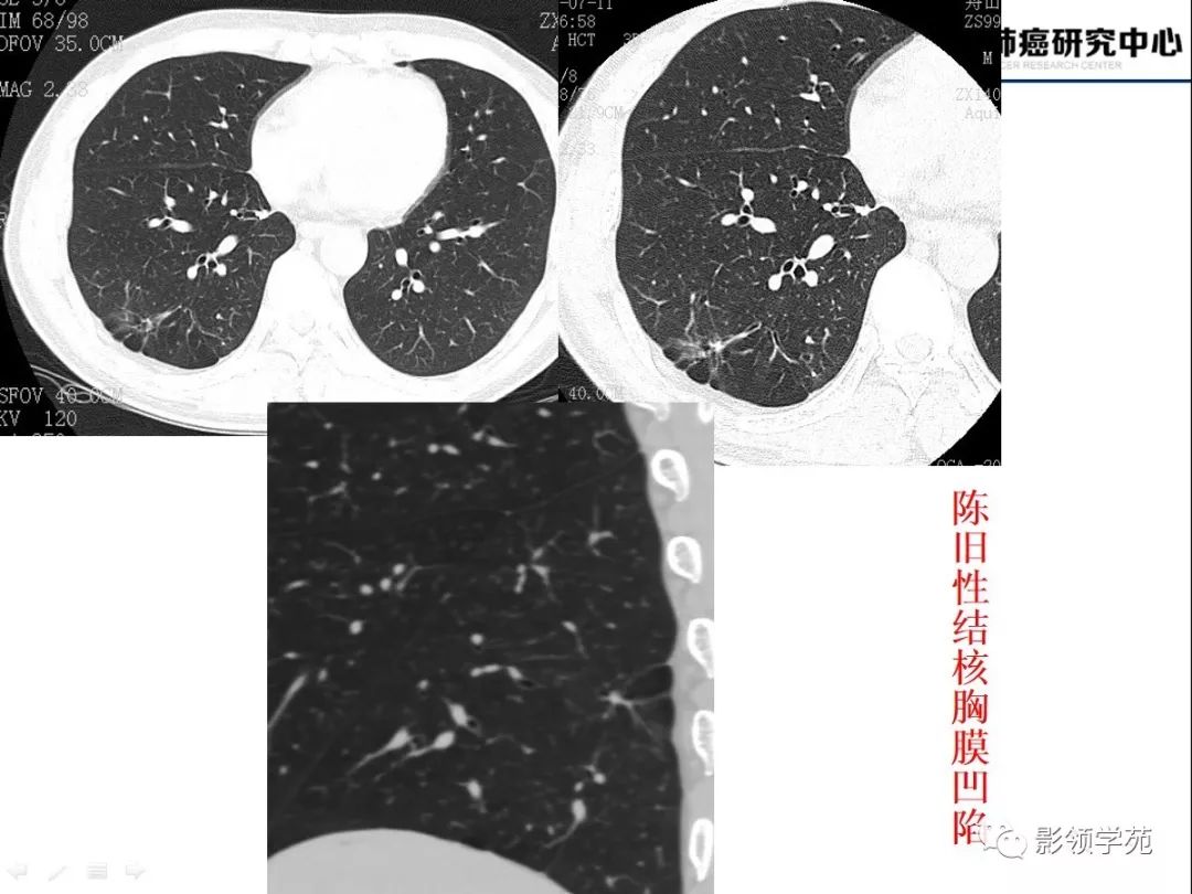 影像PPT - 【PPT】CT征象对早期肺腺癌亚型分型价值探讨—胸膜凹陷征-28 影像PPT - 【PPT】CT征象对早期肺腺癌亚型分型价值探讨—胸膜凹陷征-28