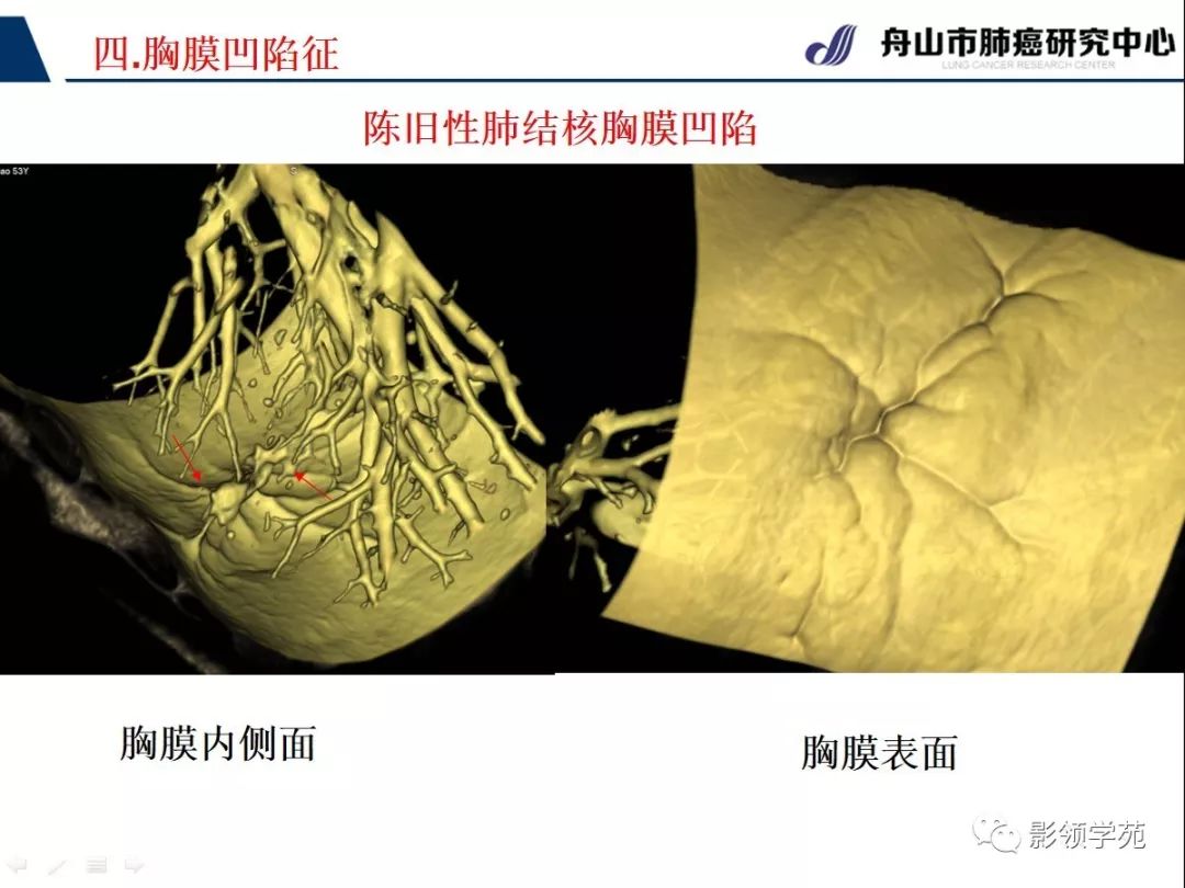 影像PPT - 【PPT】CT征象对早期肺腺癌亚型分型价值探讨—胸膜凹陷征-29 影像PPT - 【PPT】CT征象对早期肺腺癌亚型分型价值探讨—胸膜凹陷征-29