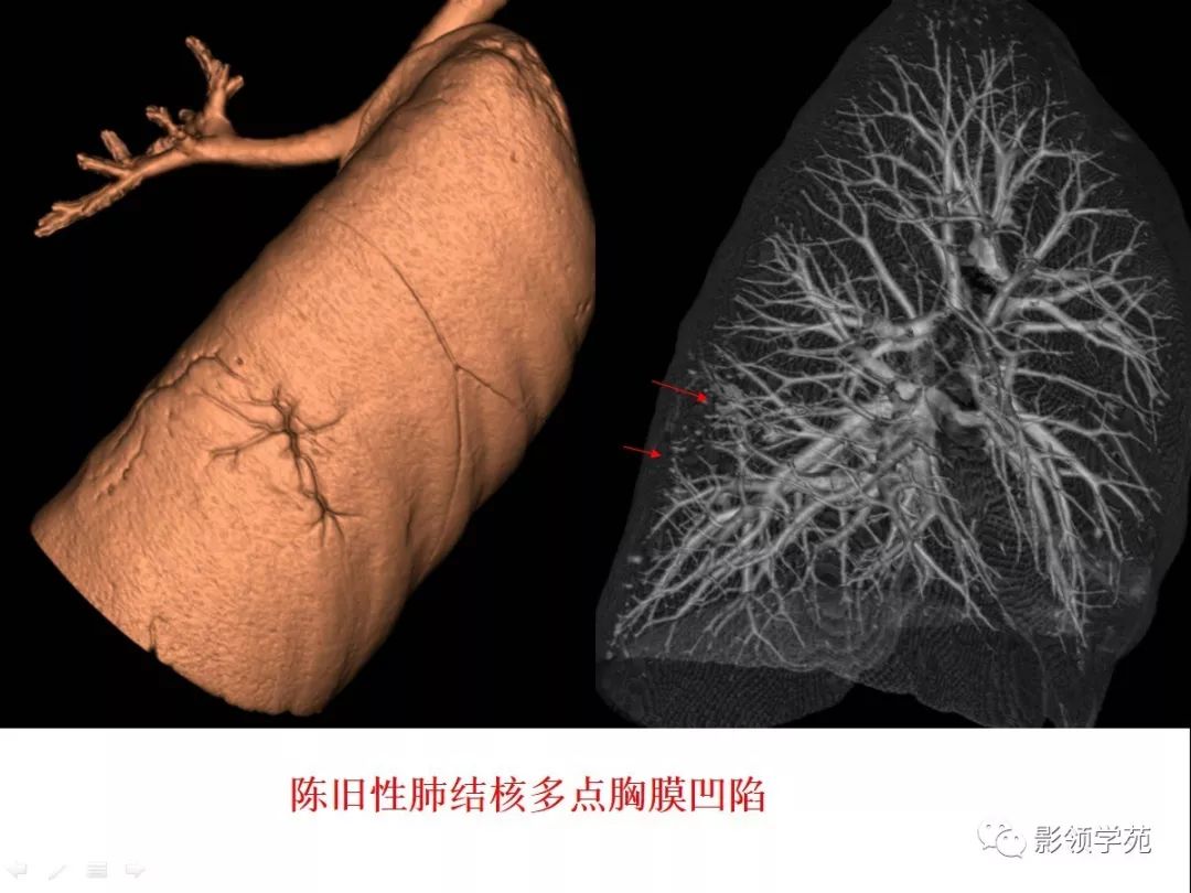 影像PPT - 【PPT】CT征象对早期肺腺癌亚型分型价值探讨—胸膜凹陷征-30 影像PPT - 【PPT】CT征象对早期肺腺癌亚型分型价值探讨—胸膜凹陷征-30
