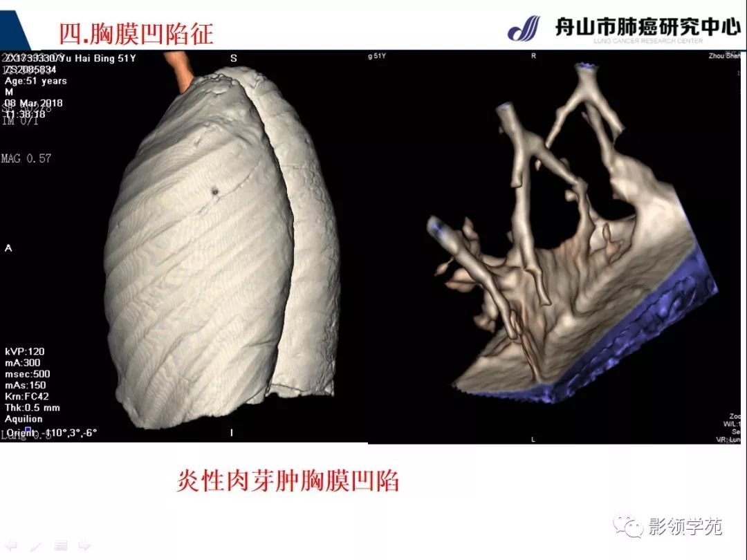 影像PPT - 【PPT】CT征象对早期肺腺癌亚型分型价值探讨—胸膜凹陷征-32 影像PPT - 【PPT】CT征象对早期肺腺癌亚型分型价值探讨—胸膜凹陷征-32