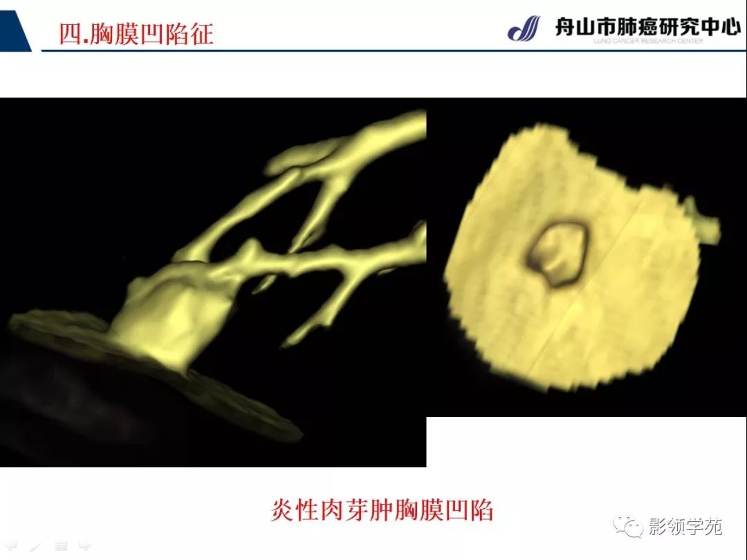 影像PPT - 【PPT】CT征象对早期肺腺癌亚型分型价值探讨—胸膜凹陷征-34 影像PPT - 【PPT】CT征象对早期肺腺癌亚型分型价值探讨—胸膜凹陷征-34