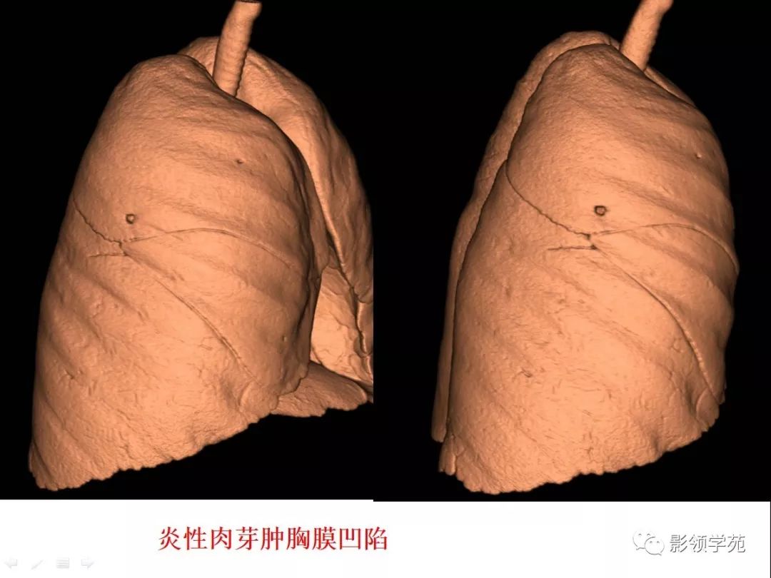 影像PPT - 【PPT】CT征象对早期肺腺癌亚型分型价值探讨—胸膜凹陷征-35 影像PPT - 【PPT】CT征象对早期肺腺癌亚型分型价值探讨—胸膜凹陷征-35