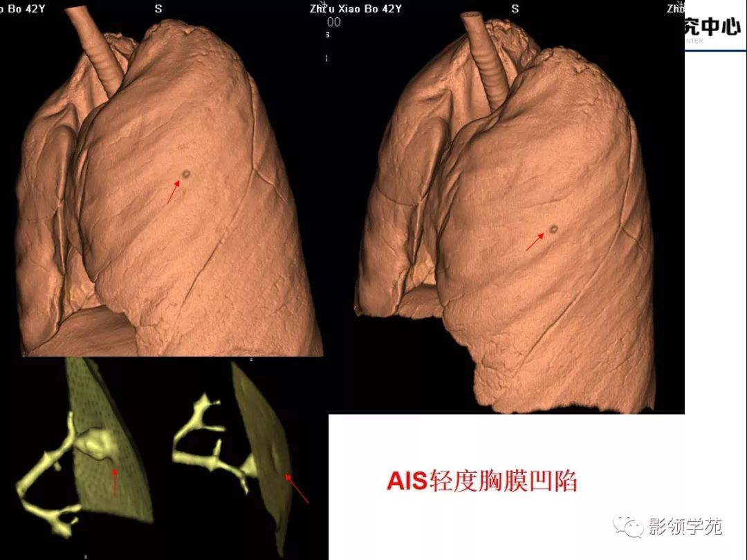 影像PPT - 【PPT】CT征象对早期肺腺癌亚型分型价值探讨—胸膜凹陷征-42 影像PPT - 【PPT】CT征象对早期肺腺癌亚型分型价值探讨—胸膜凹陷征-42