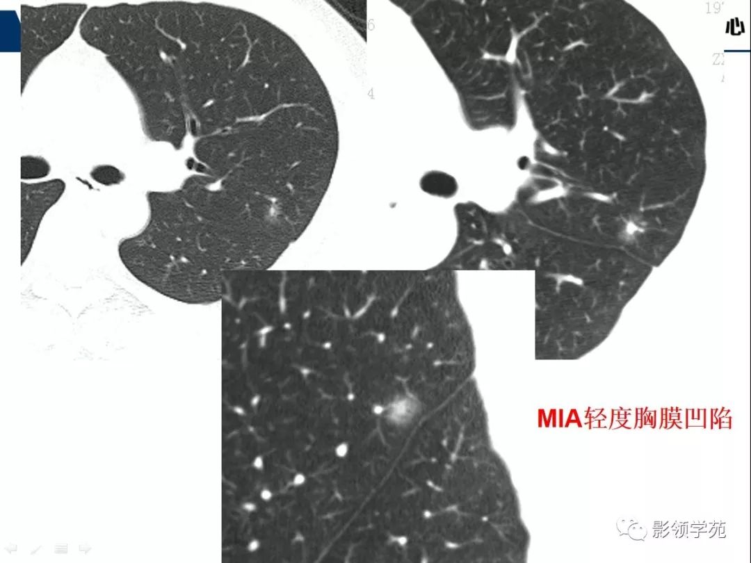 影像PPT - 【PPT】CT征象对早期肺腺癌亚型分型价值探讨—胸膜凹陷征-43 影像PPT - 【PPT】CT征象对早期肺腺癌亚型分型价值探讨—胸膜凹陷征-43
