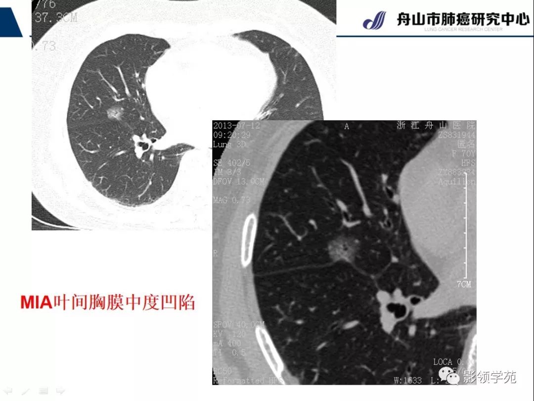 影像PPT - 【PPT】CT征象对早期肺腺癌亚型分型价值探讨—胸膜凹陷征-44 影像PPT - 【PPT】CT征象对早期肺腺癌亚型分型价值探讨—胸膜凹陷征-44