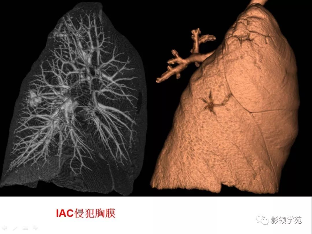 影像PPT - 【PPT】CT征象对早期肺腺癌亚型分型价值探讨—胸膜凹陷征-49 影像PPT - 【PPT】CT征象对早期肺腺癌亚型分型价值探讨—胸膜凹陷征-49