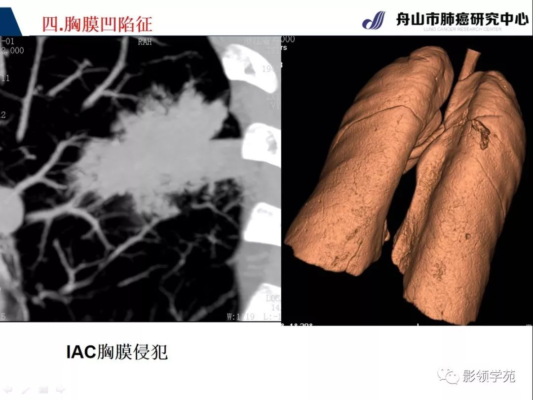 影像PPT - 【PPT】CT征象对早期肺腺癌亚型分型价值探讨—胸膜凹陷征-51 影像PPT - 【PPT】CT征象对早期肺腺癌亚型分型价值探讨—胸膜凹陷征-51