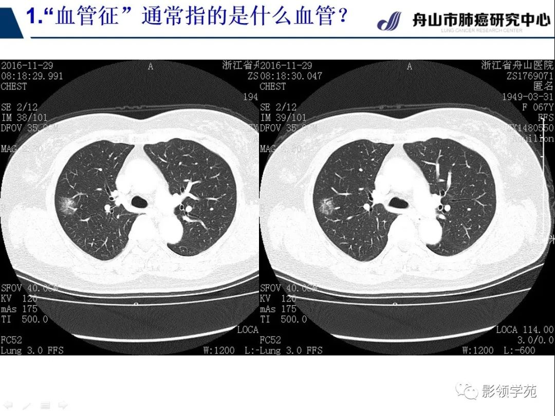 影像PPT - 【PPT】CT征象对早期肺腺癌亚型分型价值探讨—血管征-9 影像PPT - 【PPT】CT征象对早期肺腺癌亚型分型价值探讨—血管征-9