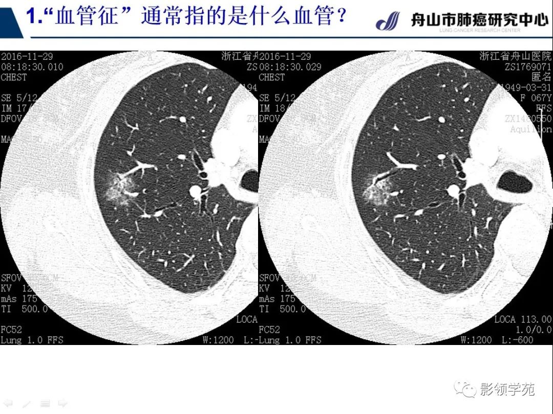 影像PPT - 【PPT】CT征象对早期肺腺癌亚型分型价值探讨—血管征-10 影像PPT - 【PPT】CT征象对早期肺腺癌亚型分型价值探讨—血管征-10