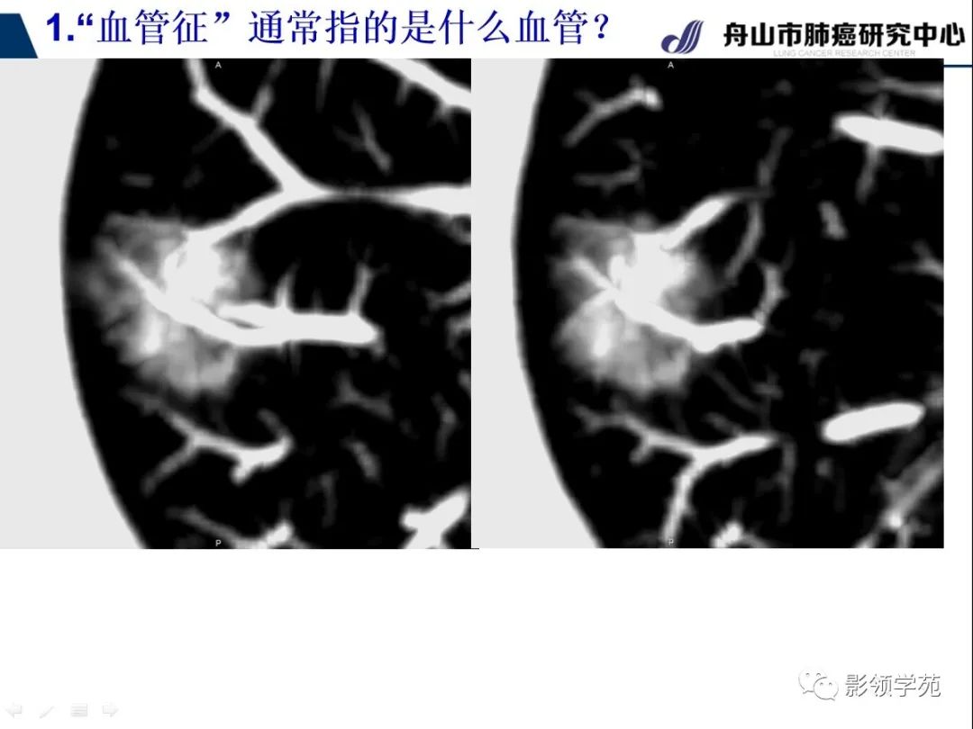 影像PPT - 【PPT】CT征象对早期肺腺癌亚型分型价值探讨—血管征-11 影像PPT - 【PPT】CT征象对早期肺腺癌亚型分型价值探讨—血管征-11