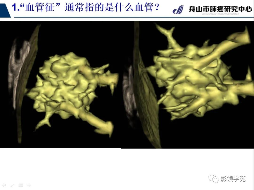 影像PPT - 【PPT】CT征象对早期肺腺癌亚型分型价值探讨—血管征-12 影像PPT - 【PPT】CT征象对早期肺腺癌亚型分型价值探讨—血管征-12