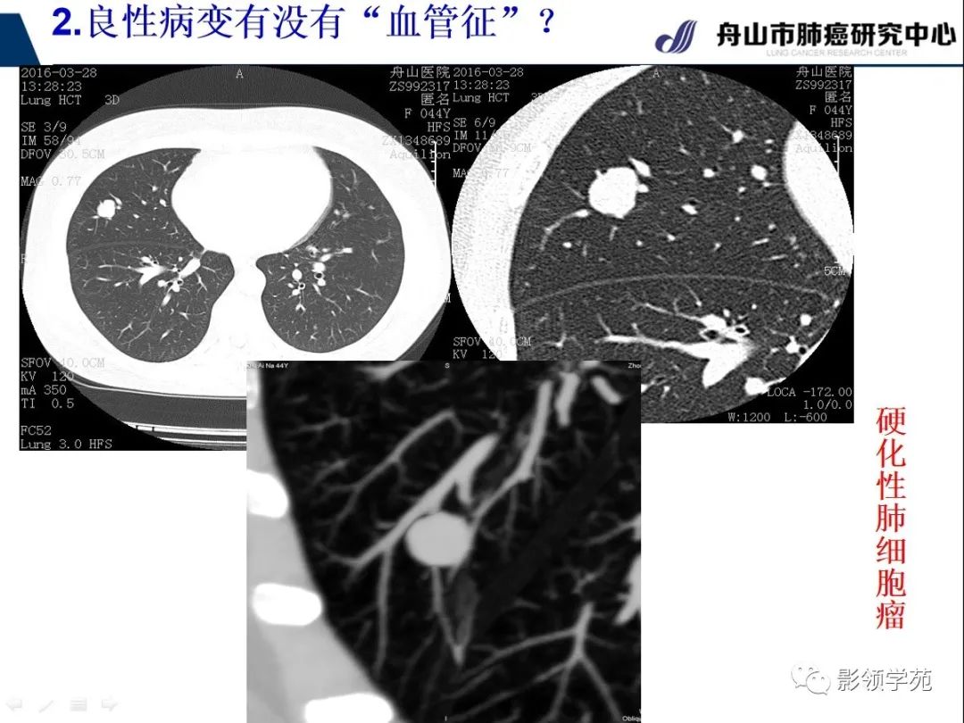 影像PPT - 【PPT】CT征象对早期肺腺癌亚型分型价值探讨—血管征-17 影像PPT - 【PPT】CT征象对早期肺腺癌亚型分型价值探讨—血管征-17