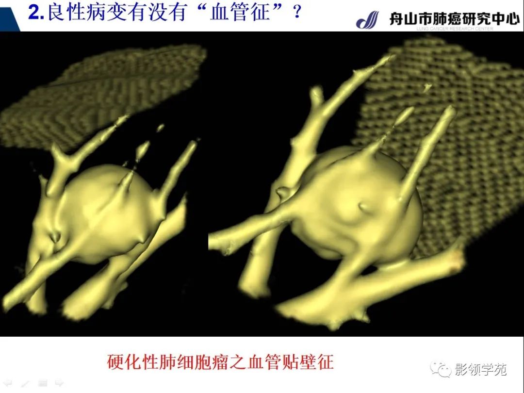 影像PPT - 【PPT】CT征象对早期肺腺癌亚型分型价值探讨—血管征-18 影像PPT - 【PPT】CT征象对早期肺腺癌亚型分型价值探讨—血管征-18