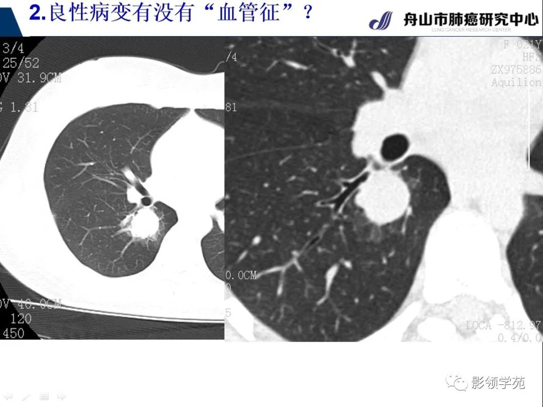 影像PPT - 【PPT】CT征象对早期肺腺癌亚型分型价值探讨—血管征-19 影像PPT - 【PPT】CT征象对早期肺腺癌亚型分型价值探讨—血管征-19