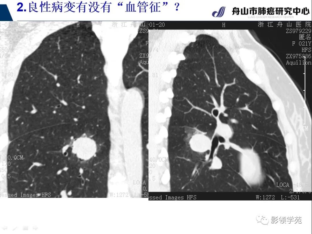 影像PPT - 【PPT】CT征象对早期肺腺癌亚型分型价值探讨—血管征-20 影像PPT - 【PPT】CT征象对早期肺腺癌亚型分型价值探讨—血管征-20