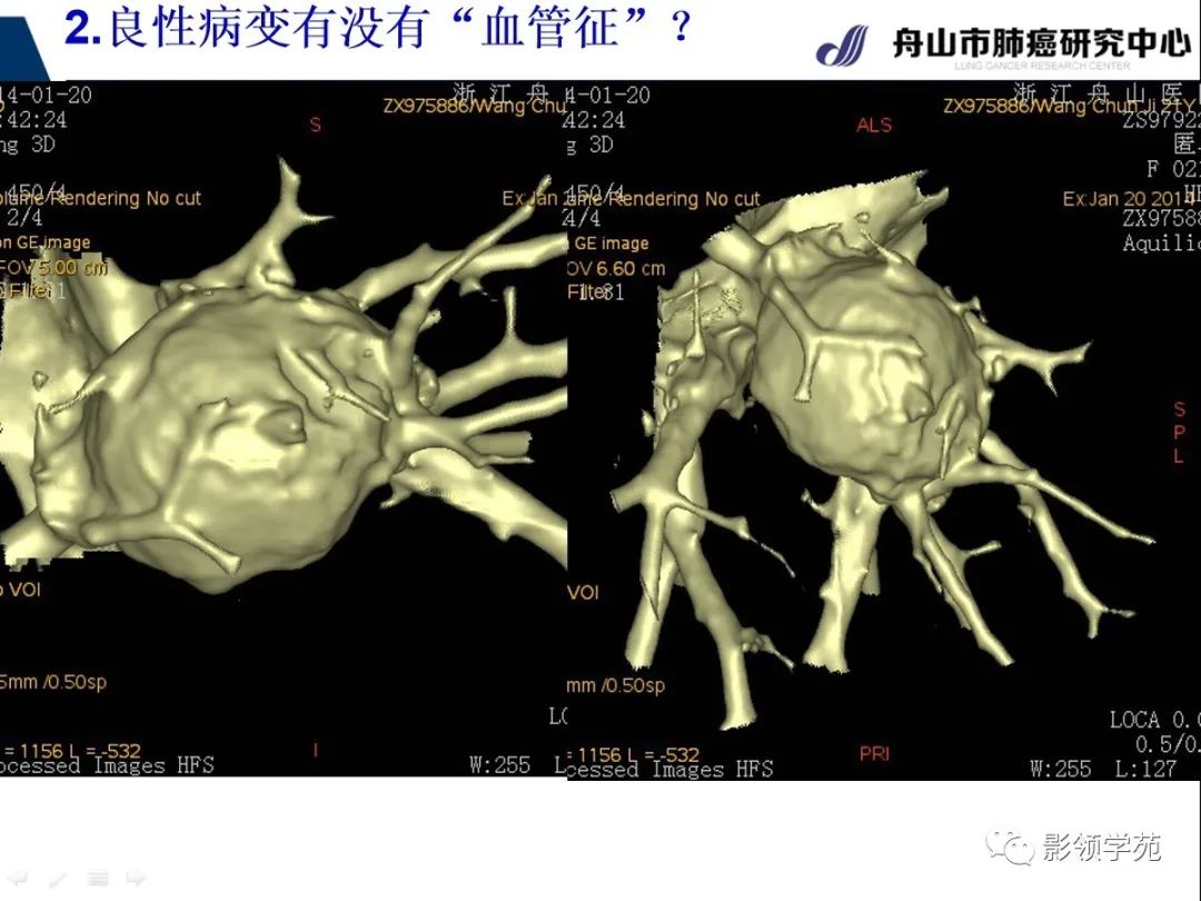 影像PPT - 【PPT】CT征象对早期肺腺癌亚型分型价值探讨—血管征-21 影像PPT - 【PPT】CT征象对早期肺腺癌亚型分型价值探讨—血管征-21
