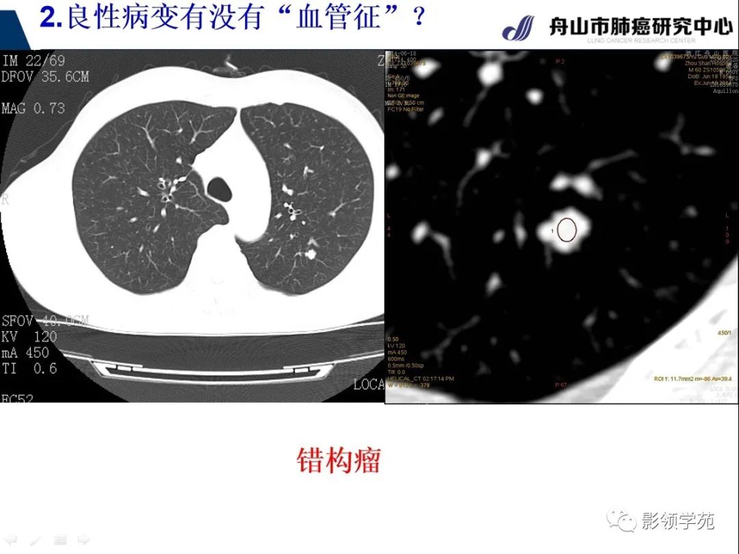影像PPT - 【PPT】CT征象对早期肺腺癌亚型分型价值探讨—血管征-22 影像PPT - 【PPT】CT征象对早期肺腺癌亚型分型价值探讨—血管征-22