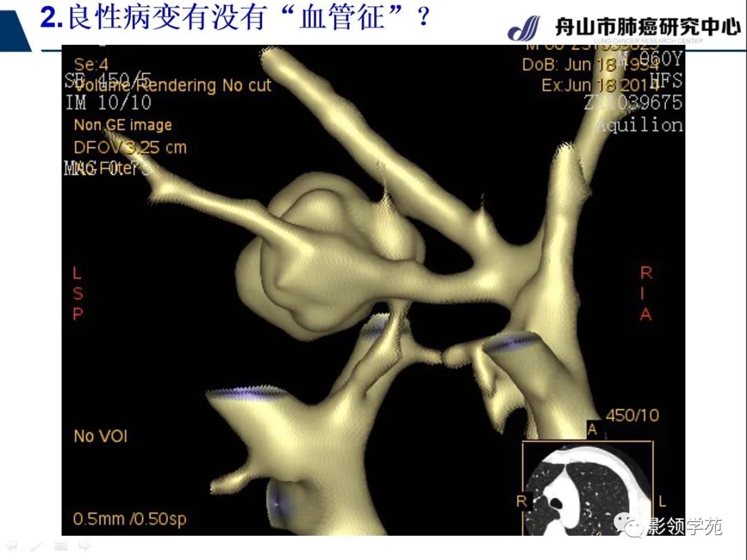 影像PPT - 【PPT】CT征象对早期肺腺癌亚型分型价值探讨—血管征-23 影像PPT - 【PPT】CT征象对早期肺腺癌亚型分型价值探讨—血管征-23