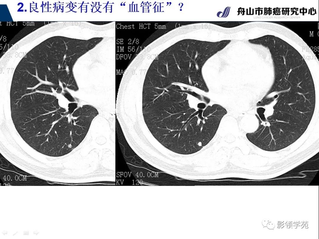 影像PPT - 【PPT】CT征象对早期肺腺癌亚型分型价值探讨—血管征-24 影像PPT - 【PPT】CT征象对早期肺腺癌亚型分型价值探讨—血管征-24