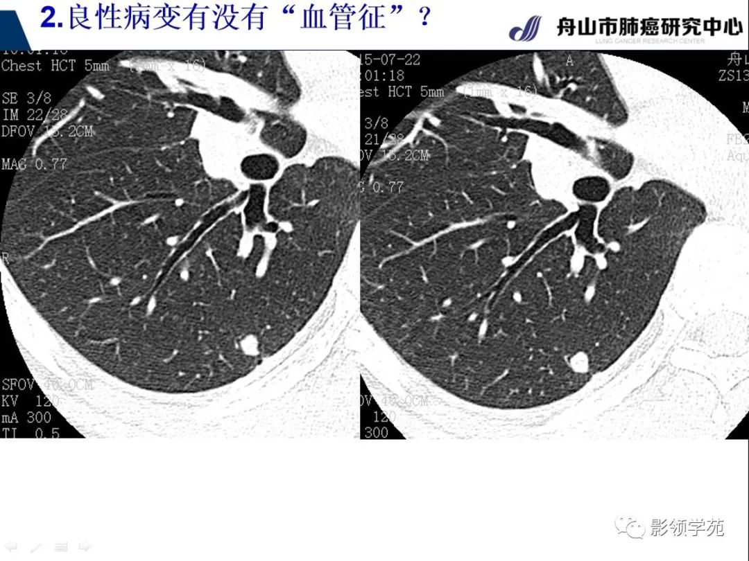 影像PPT - 【PPT】CT征象对早期肺腺癌亚型分型价值探讨—血管征-25 影像PPT - 【PPT】CT征象对早期肺腺癌亚型分型价值探讨—血管征-25