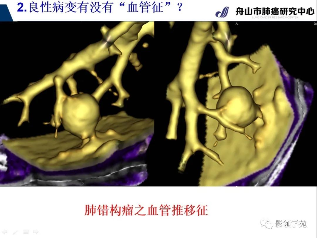 影像PPT - 【PPT】CT征象对早期肺腺癌亚型分型价值探讨—血管征-26 影像PPT - 【PPT】CT征象对早期肺腺癌亚型分型价值探讨—血管征-26