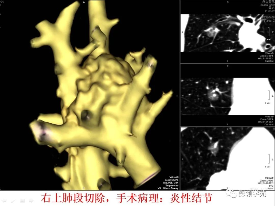 影像PPT - 【PPT】CT征象对早期肺腺癌亚型分型价值探讨—血管征-27 影像PPT - 【PPT】CT征象对早期肺腺癌亚型分型价值探讨—血管征-27